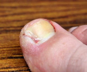 Painful Ingrown Toenails